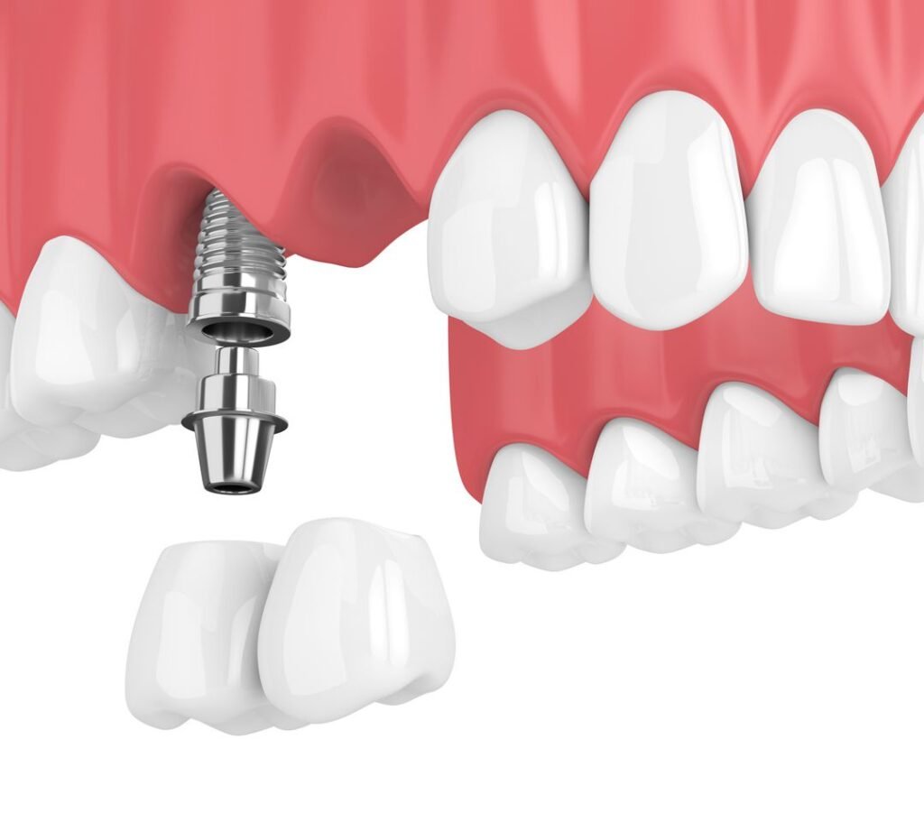 Screw-Retained