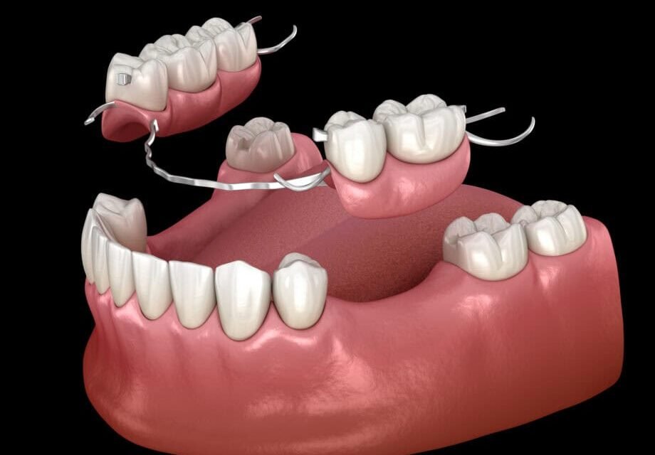 Partial Dentures