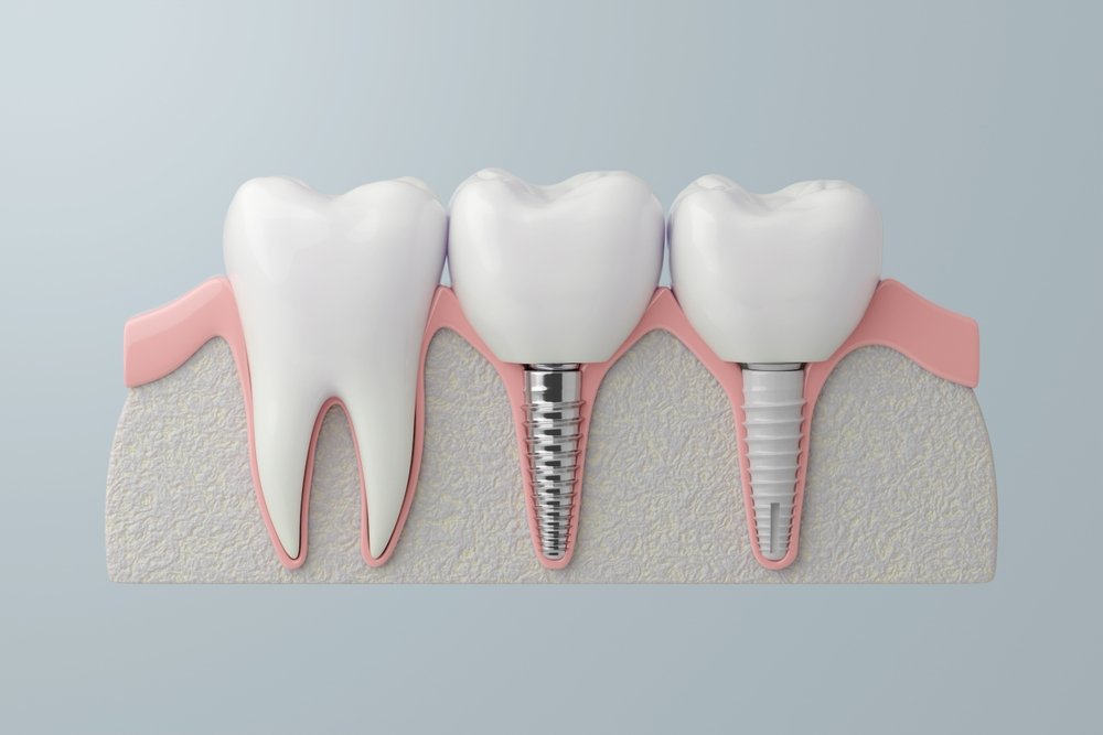 Zirconia vs Titanium Dental Implants